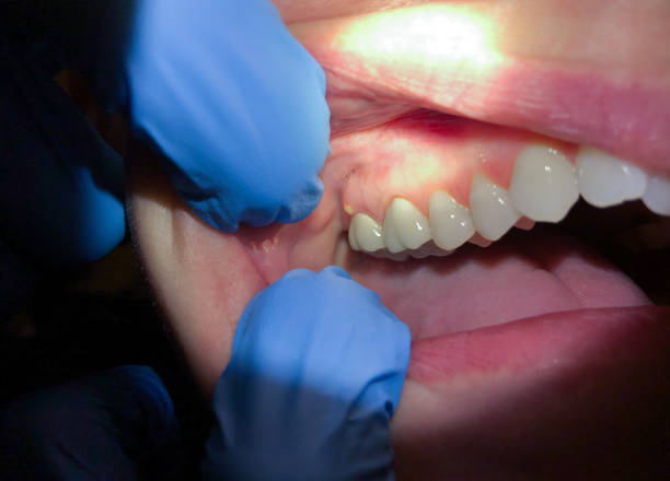 Best Emergency Dentist for Lost Fillings or Crowns in Dolton, IL