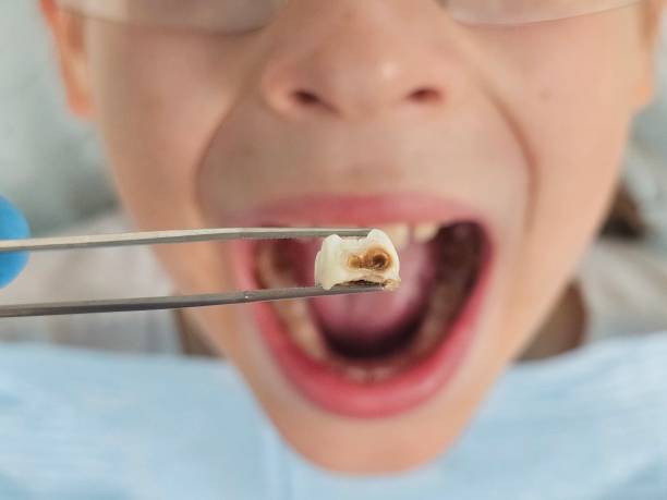Best Emergency Root Canal Treatment in Dolton, IL